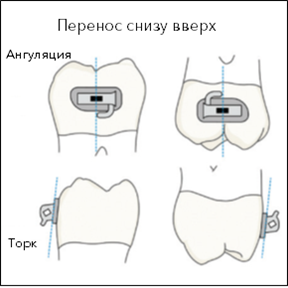 Перенос щечной трубки для нижнего правого второго моляра на верхний левый первый и правый моляры использует преимущество щечной трубки – дистальное отклонение 0°