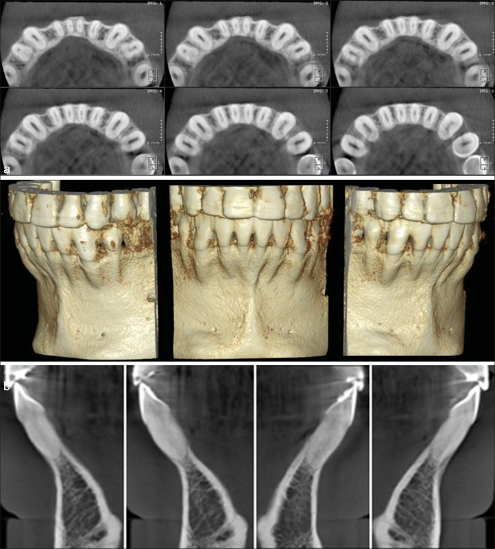 (a-c) Данные конусно-лучевой компьютерной томографии через 4 года после лечения, нормальное покрытие без явных побочных эффектов от ортодонтического лечения.